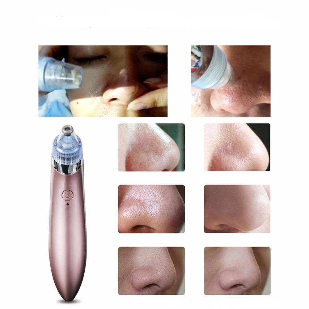 Extracteur de points noirs électrique